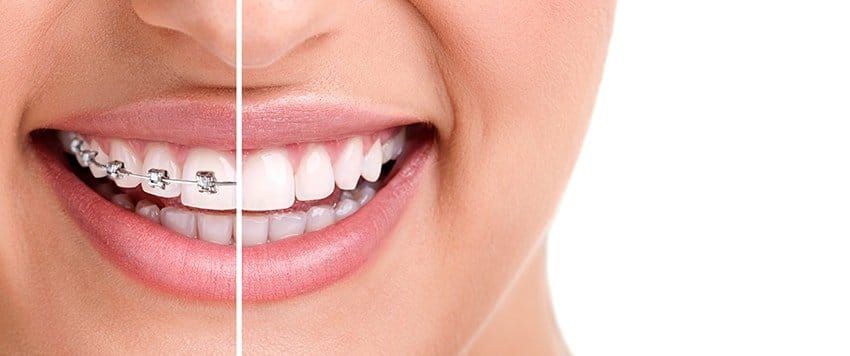 A split smile of a woman with braces and Invisalign.