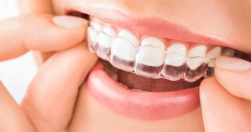 Lady placing Invisalign braces on her teeth