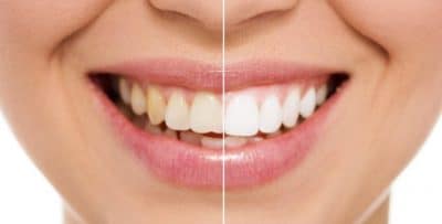 Teeth whitening comparison
